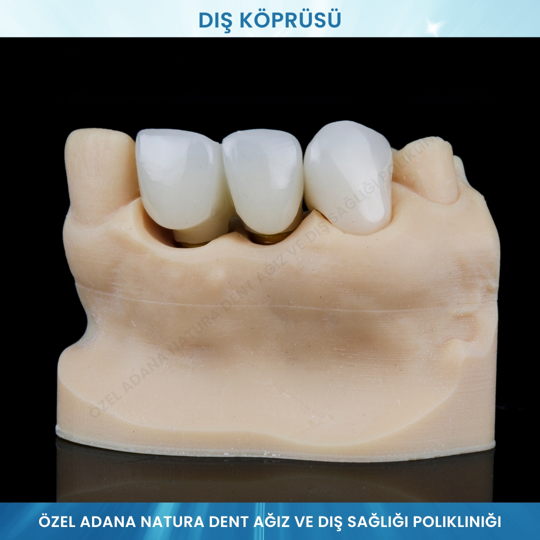 Diş Köprüsü