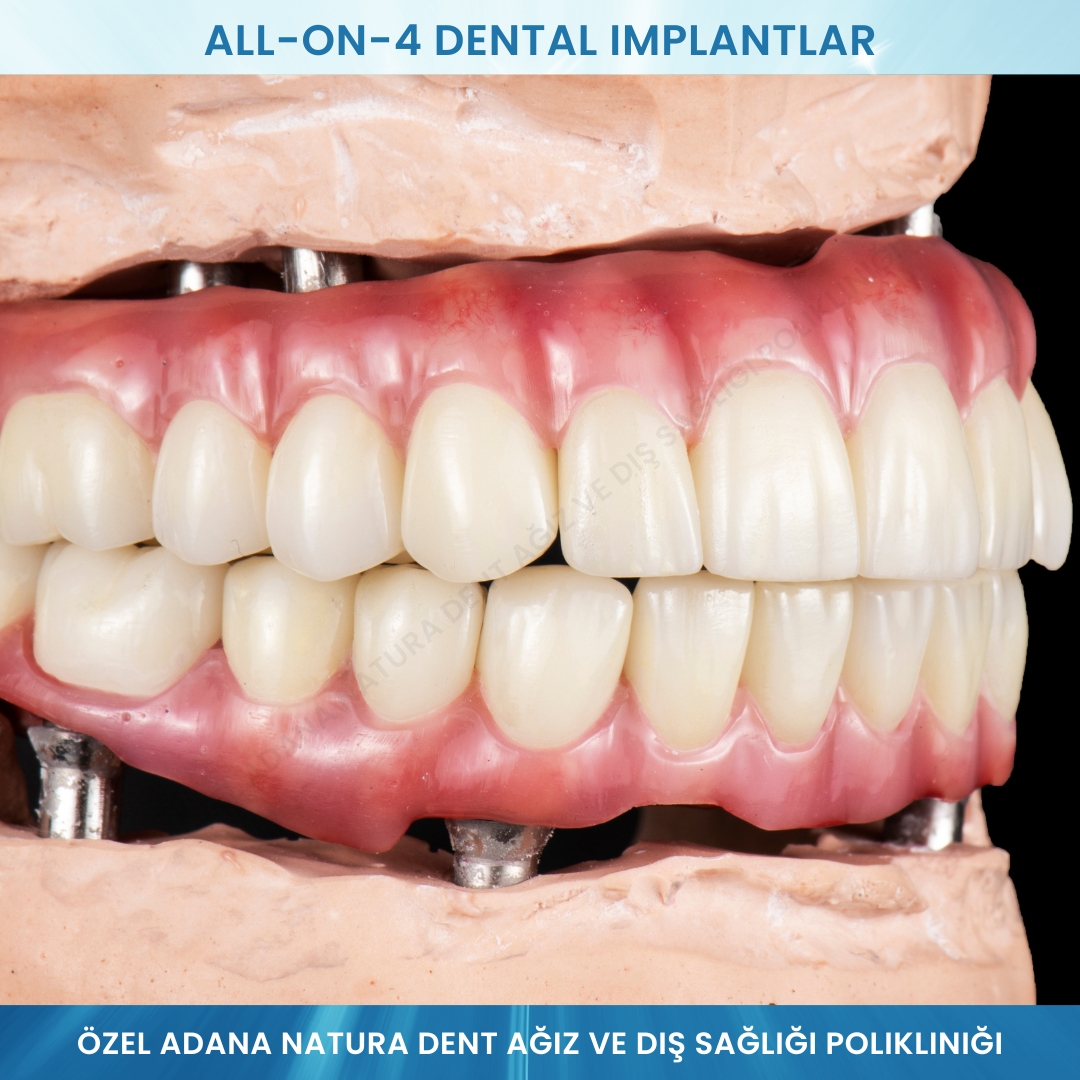 All-on-4 Dental İmplantlar
