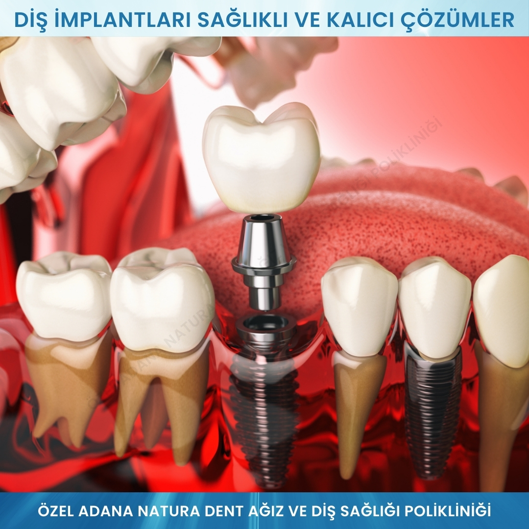 Diş İmplantları