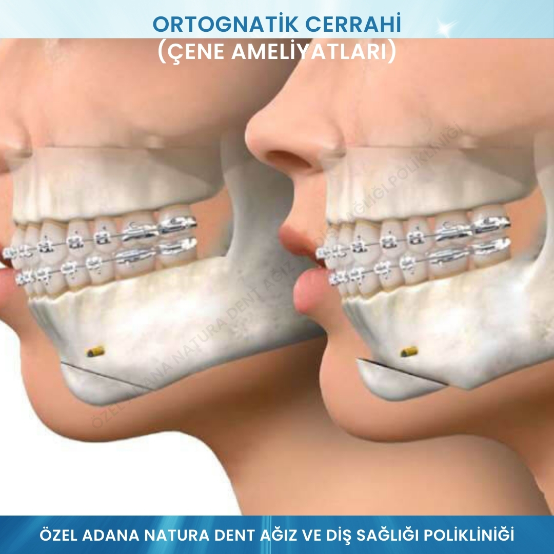 Ortognatik Cerrahi (Çene Ameliyatları)