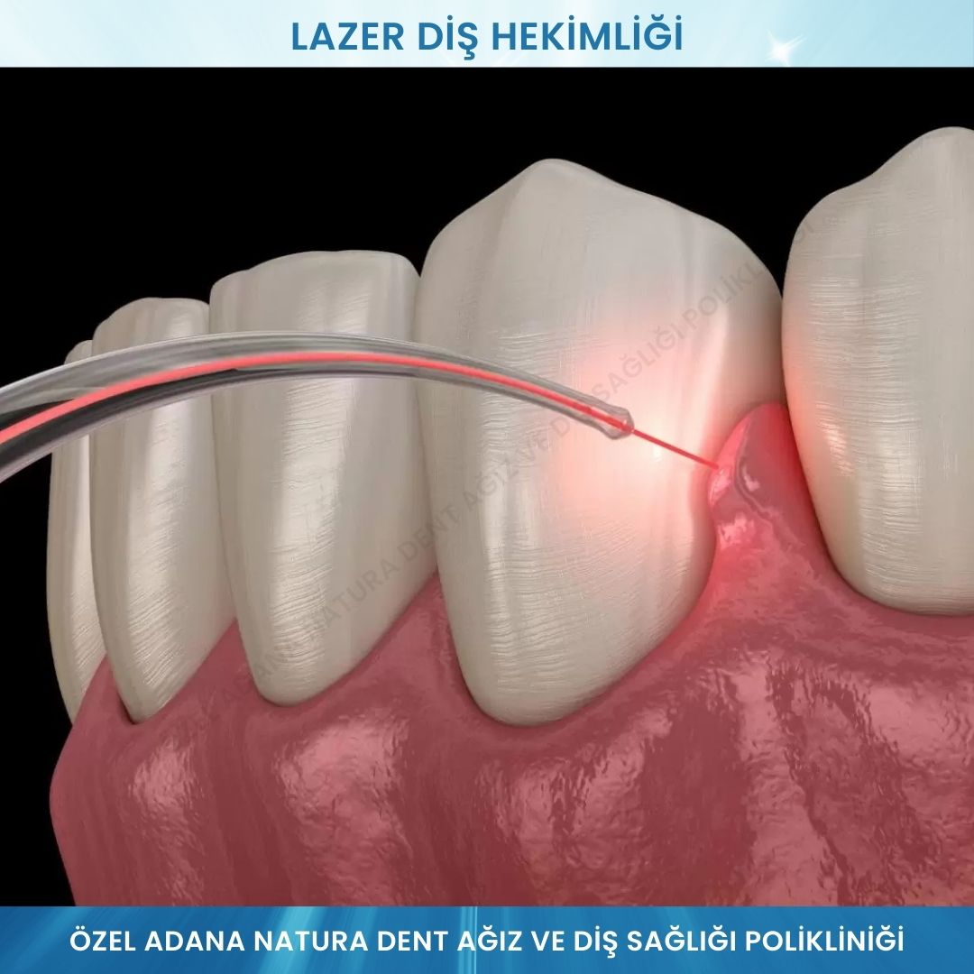 Lazer Diş Hekimliği
