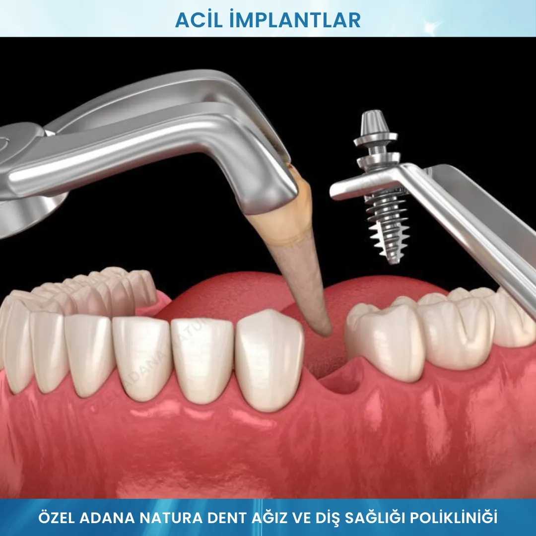 Acil İmplantlar: Hızla Sonuç Alın, Zamanı Kazanın