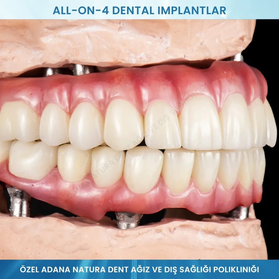 All-on-4 Dental İmplantlar: Hızlı ve Kalıcı Gülüşler İçin Mükemmel Çözüm
