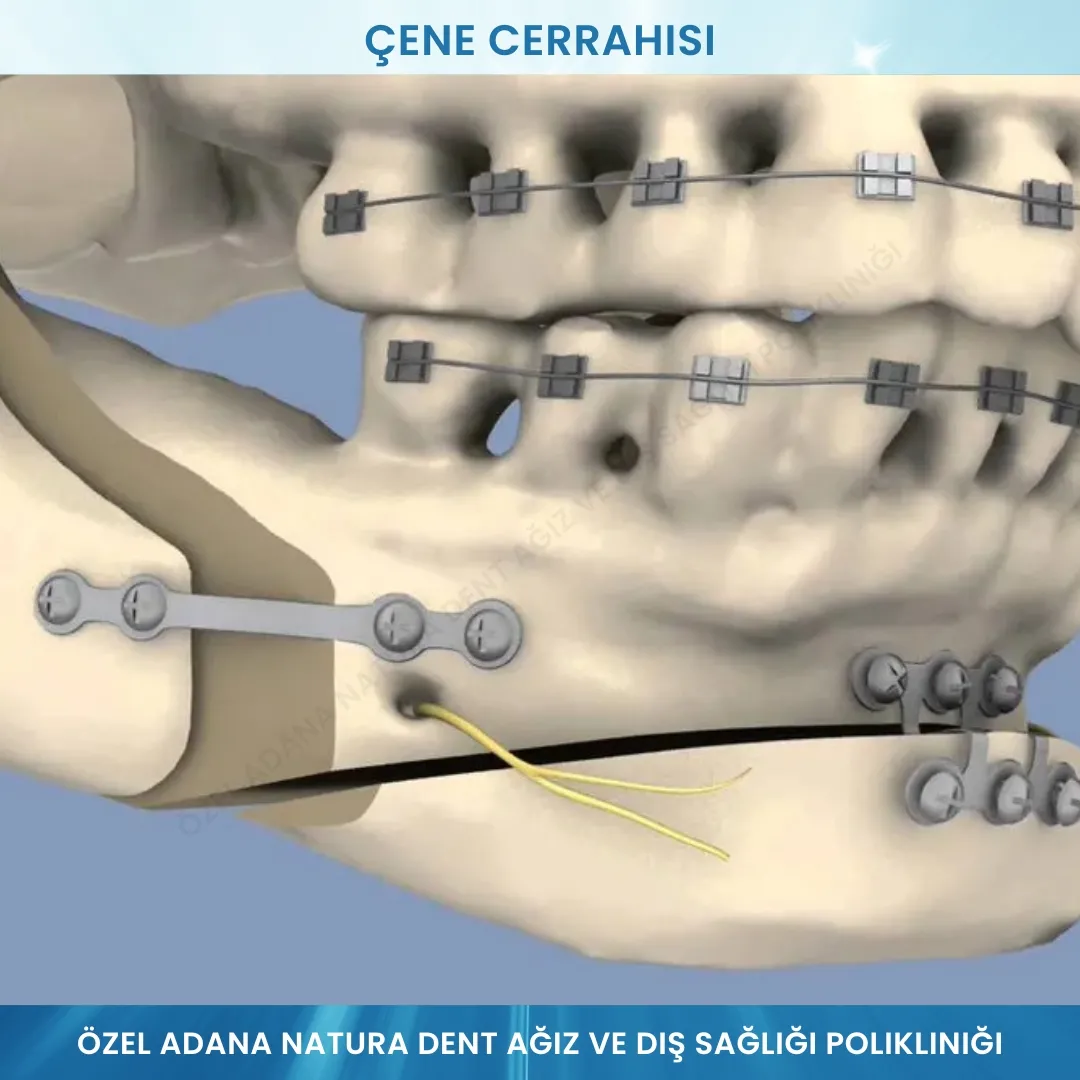 Çene Cerrahisi: Dengeli Yüz Oranları ve Fonksiyonel İyileşme İçin Profesyonel Çözüm