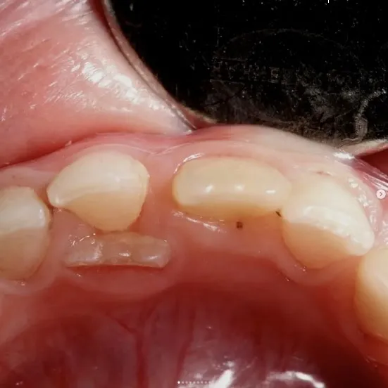 Çocuğumun Dişinin Arkasından Diş Geldi, Ne Yapmalıyım?