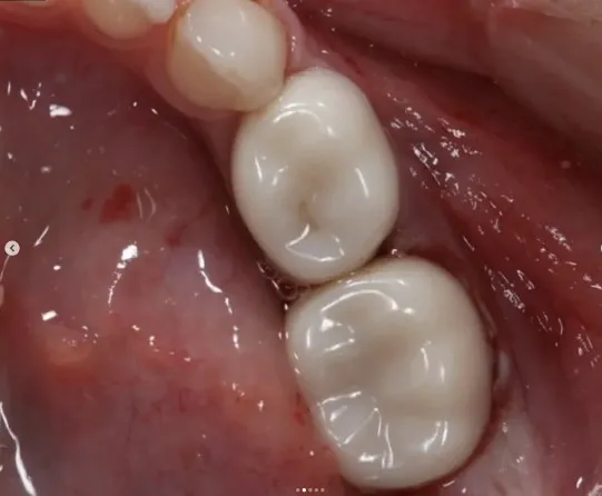 Çocuk Diş Kaplaması Nedir, Zararlı mı, Yaptırmak Gerekli mi?