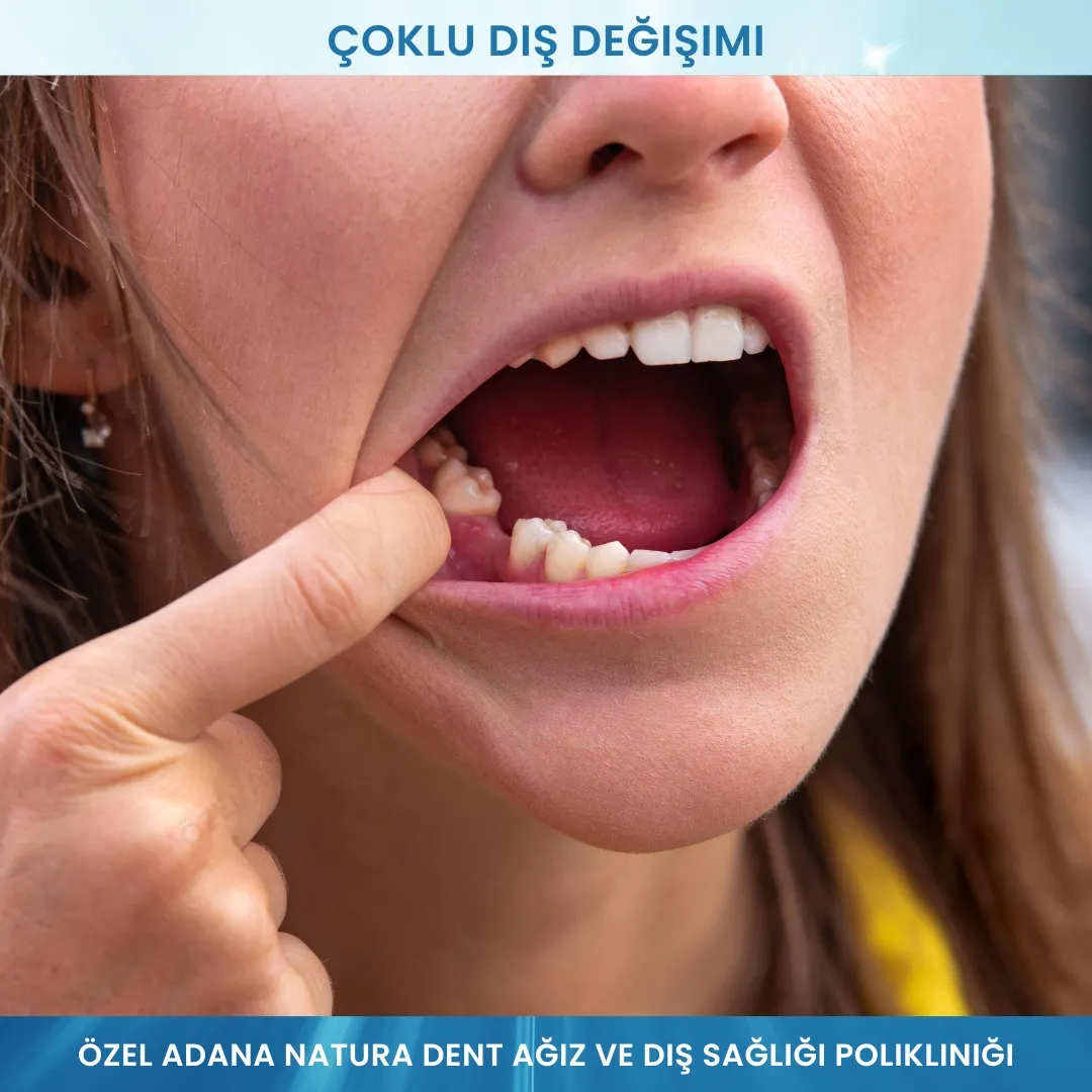 Çoklu Diş Replasmanı: Eksik Dişlerinize Kalıcı ve Ekonomik Çözümler