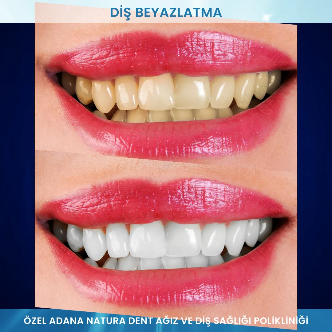 Diş Beyazlatma: Gülüşünüzü Aydınlatan Profesyonel Çözüm