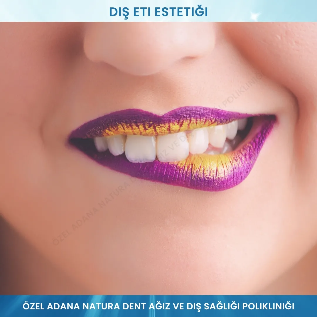Diş Eti Estetiği: Gülüşünüzü Mükemmelleştiren Profesyonel Tedavi