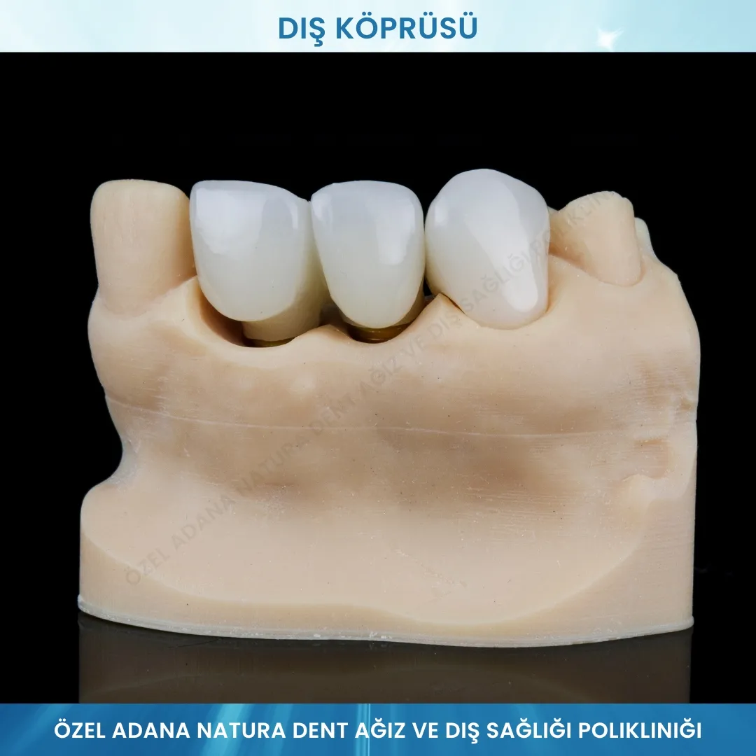 Diş Köprüsü: Eksik Dişler İçin Doğal ve Kalıcı Çözümler