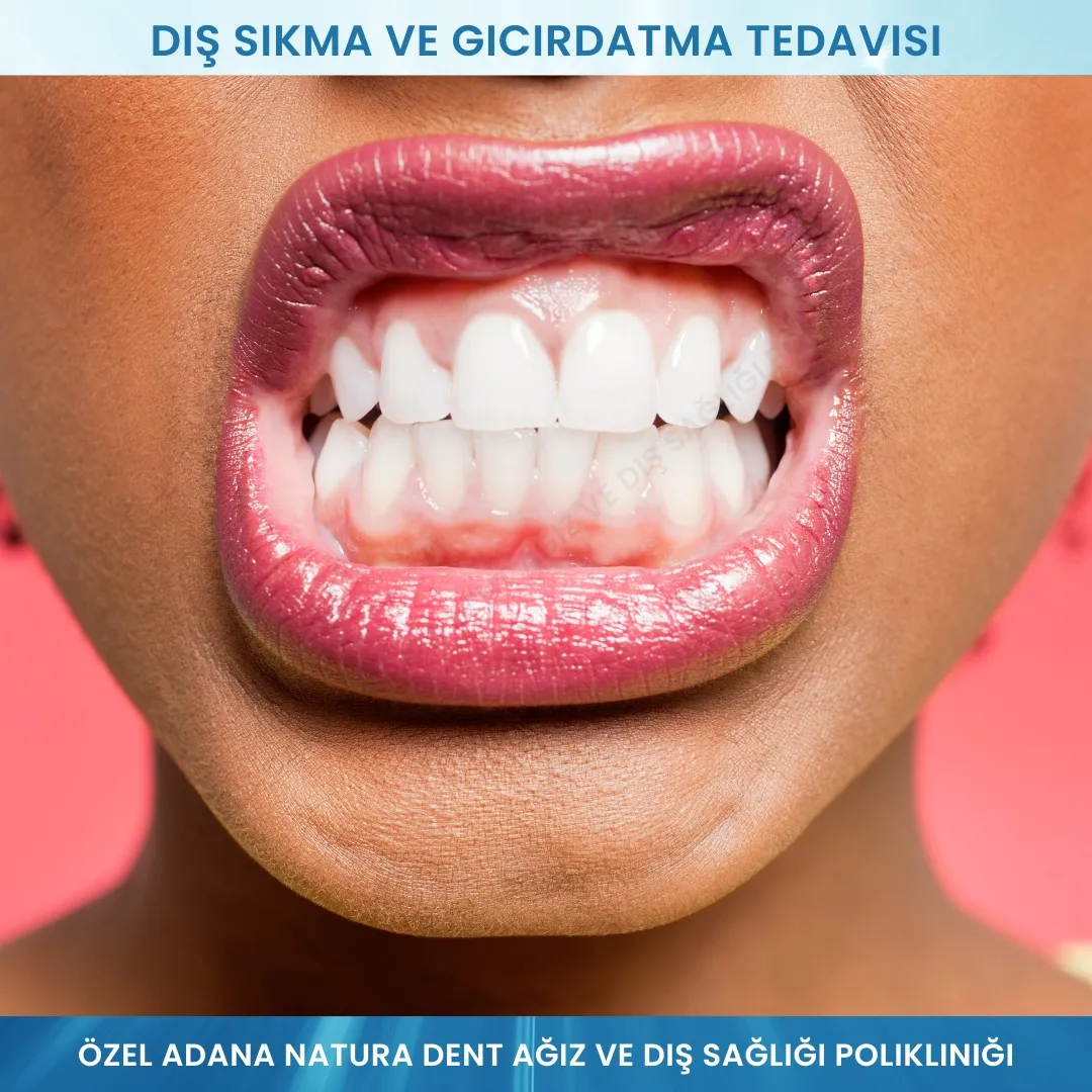 Diş Sıkma ve Gıcırdatma Tedavisi (Bruksizm ve Clenching)