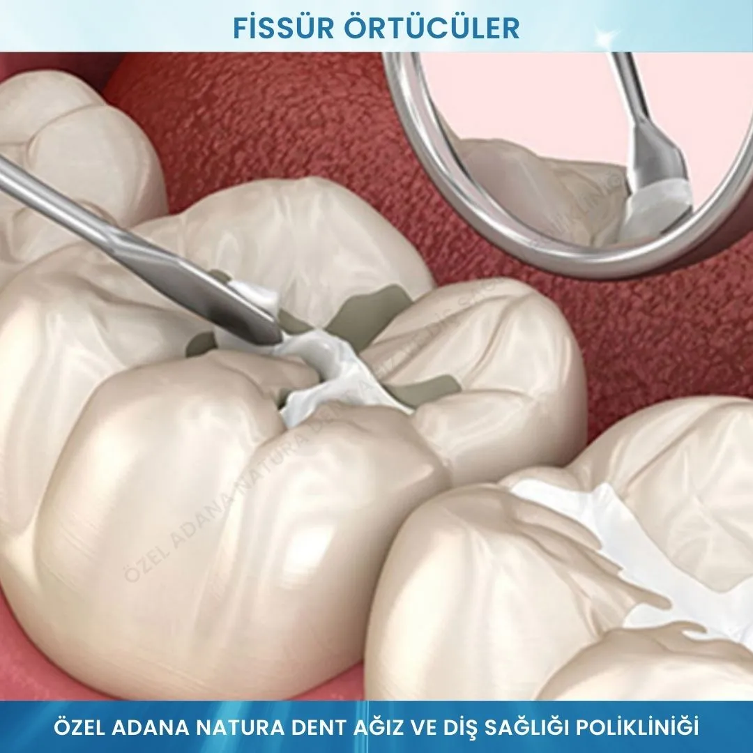 Fissür Örtücüler: Çocuklar İçin Etkili Çürük Önleme Yöntemi