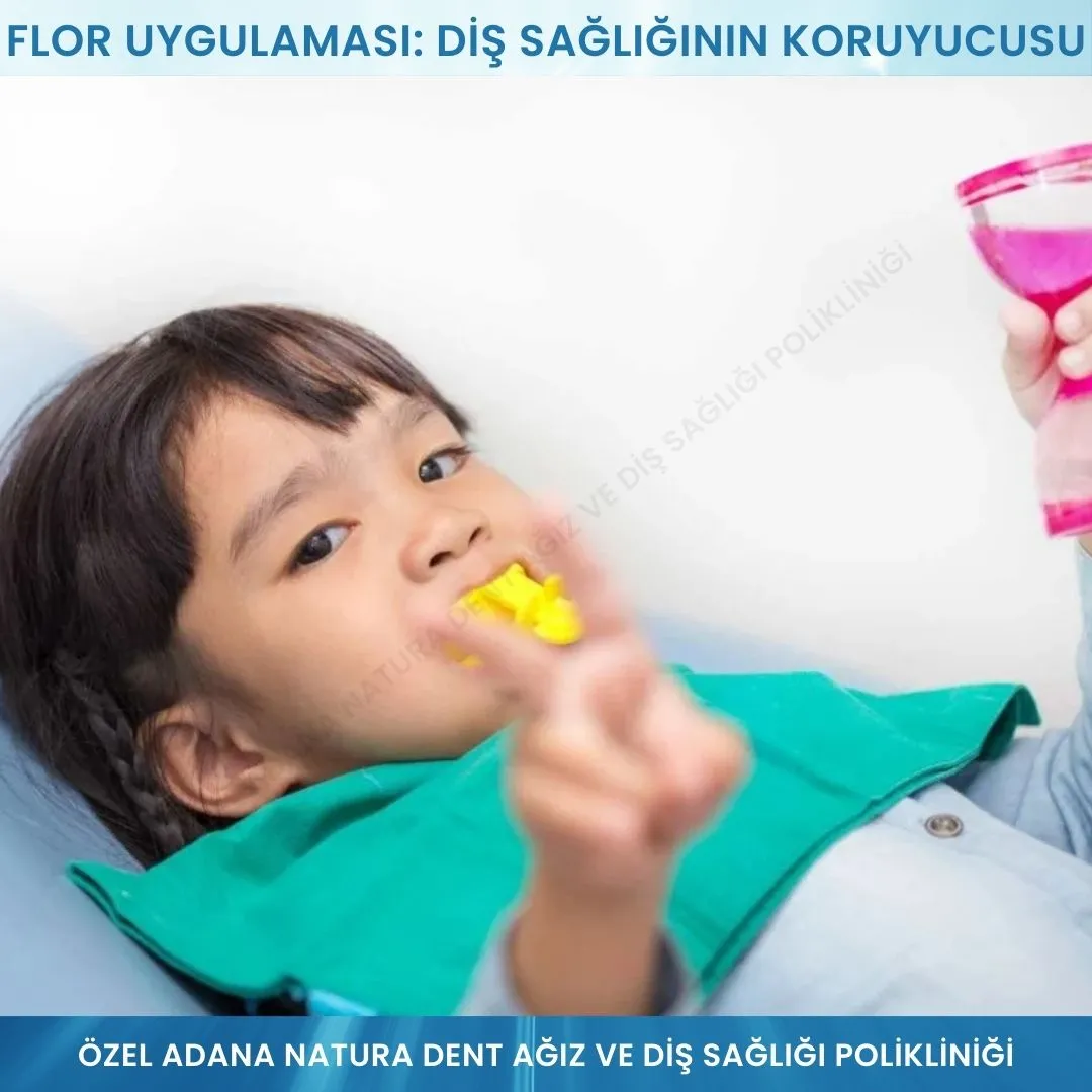 Flor Uygulaması: Diş Sağlığının Koruyucusu