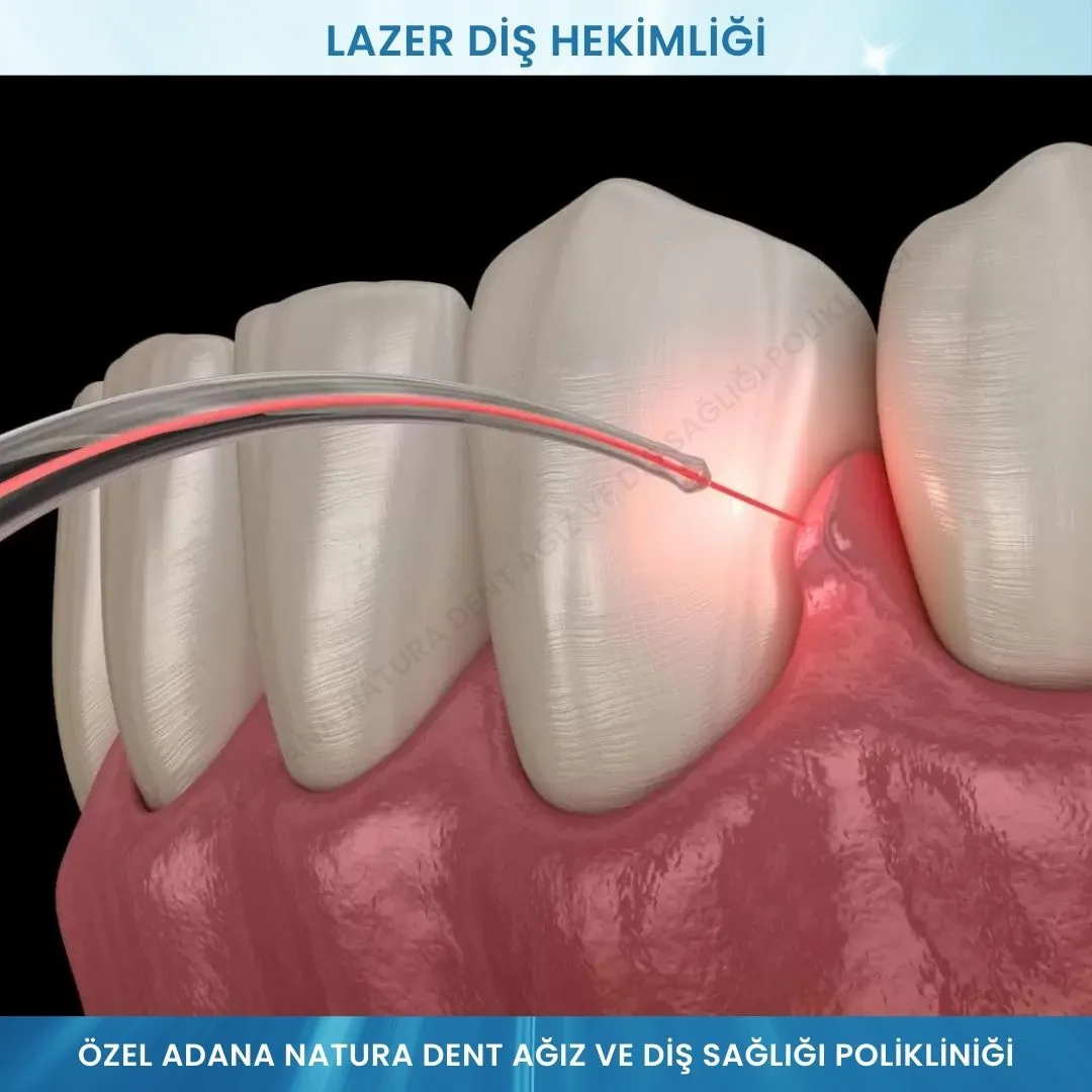 Lazer Diş Hekimliği: Ağrısız, Kanamasız ve Hızlı Tedavi Çözümleri