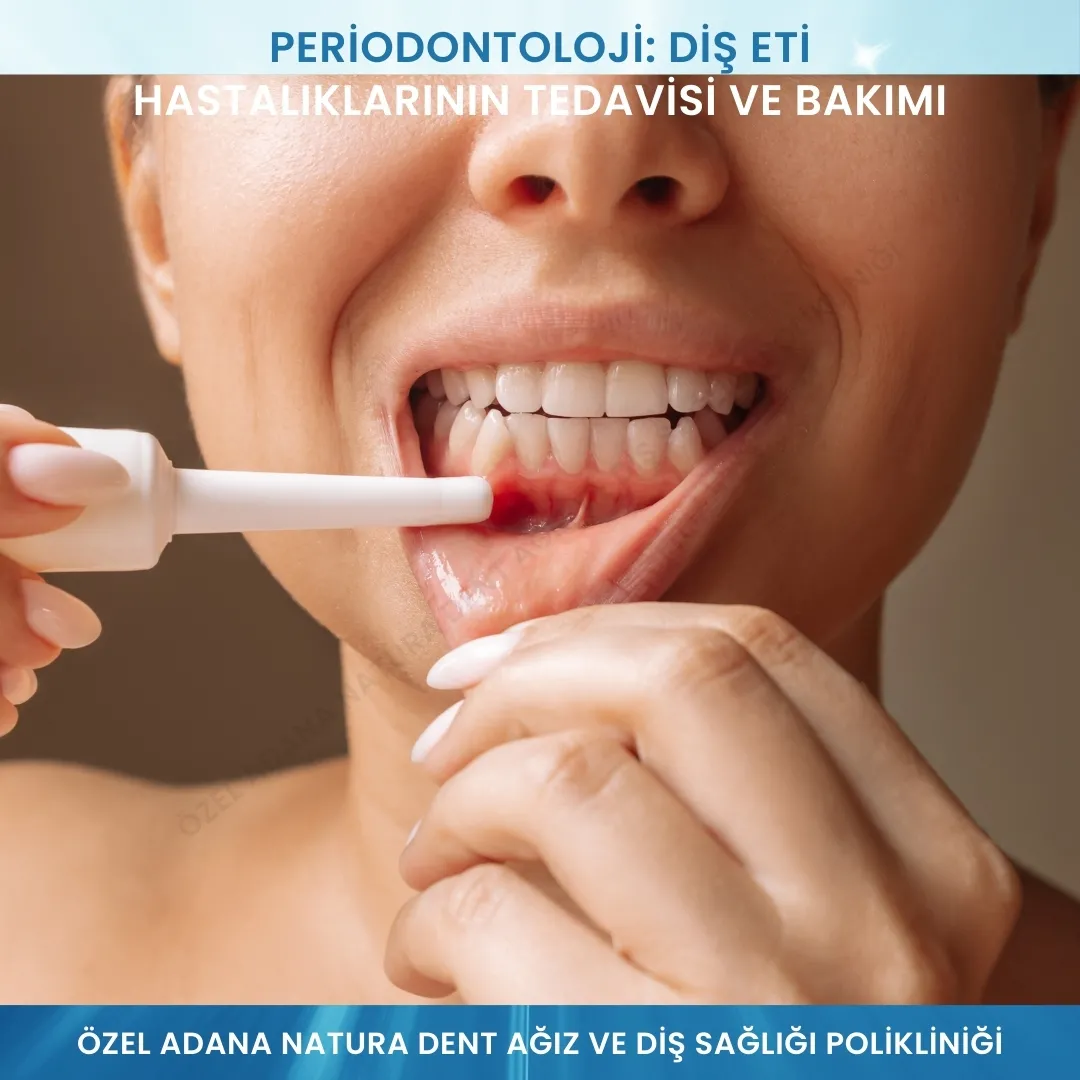 Periodontoloji: Diş Eti Hastalıklarının Tedavisi ve Bakımı