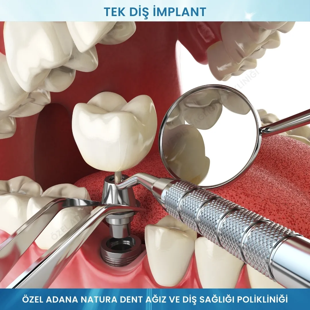 Tek Diş İmplant: Eksik Dişinize Kalıcı ve Doğal Çözüm